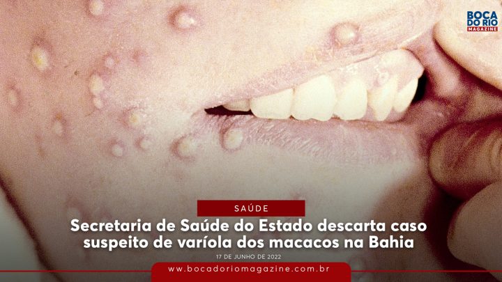 Secretaria de Saúde do Estado descarta caso suspeito de varíola dos macacos na Bahia