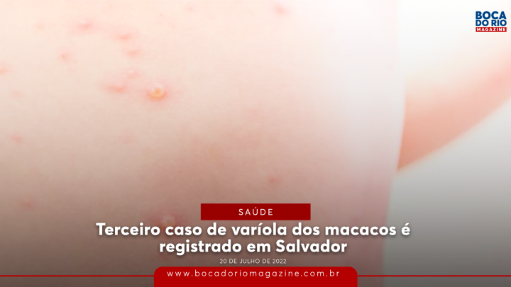 Terceiro caso de varíola dos macacos é registrado em Salvador