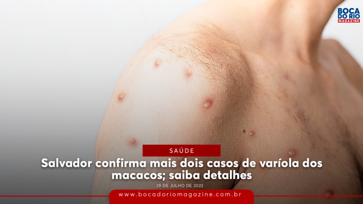 Salvador confirma mais dois casos de varíola dos macacos; saiba detalhes