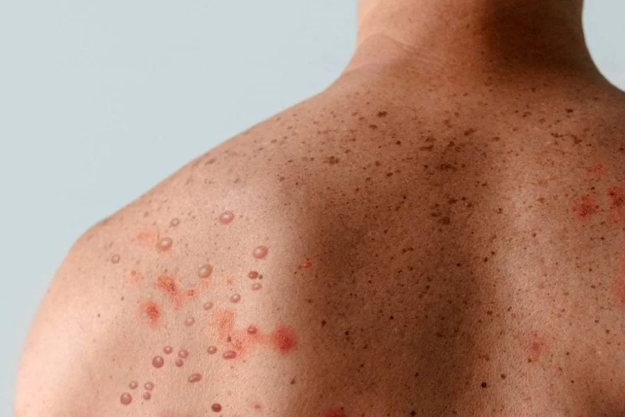 Porto Alegre confirma o primeiro caso de mpox. Veja quais são os sintomas da doença, como ocorre a transmissão e os cuidados recomendados pelas autoridades de saúde.