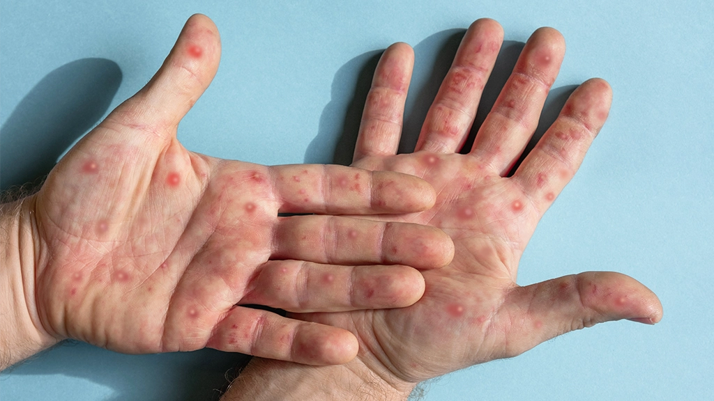 Porto Alegre confirma primeiro caso de mpox; veja sintomas e cuidados