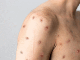 Monkeypox (Mpox)