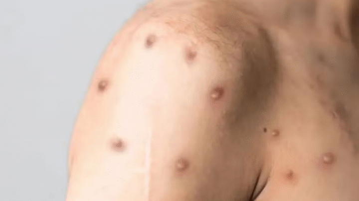 Mpox em Minas Gerais: Grande BH registra 12 dos 13 casos da doença no estado