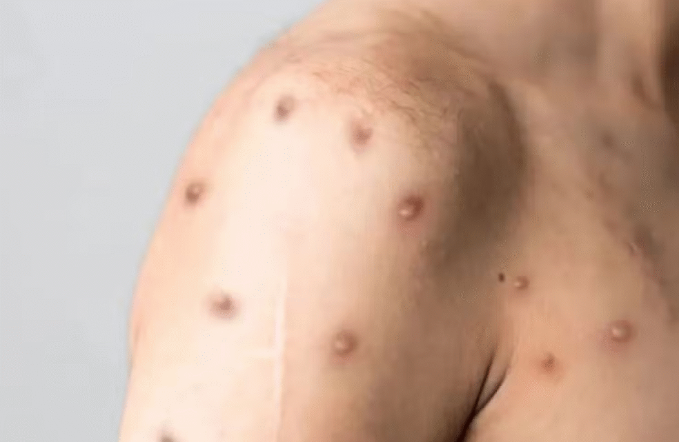 Mpox em Minas Gerais: Grande BH registra 12 dos 13 casos da doença no estado