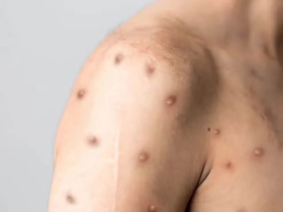 Casos de mpox sobem para 13 em Minas Gerais com novo registro em Contagem. Veja sintomas, locais com mais casos e quem pode vacinar hoje (13/03).