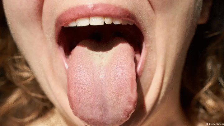 Câncer gástrico e colorretal podem ser identificados por bactérias da saliva segundo estudo